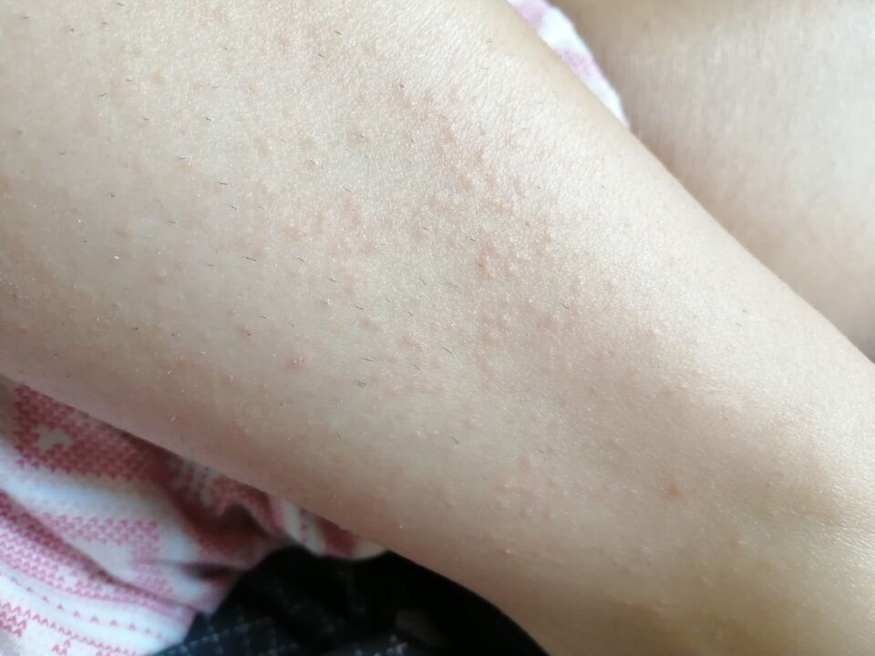 Elena developed a rash on her legs before taking Germivir tablets