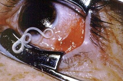 A worm in a person's eyes