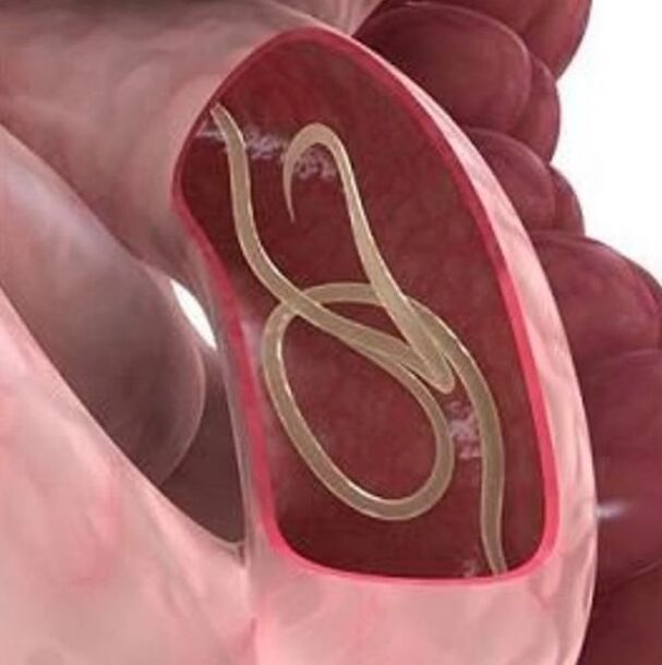 Signs of worms in the gastrointestinal tract